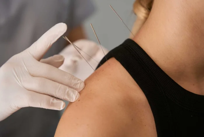 طب سوزنی چینی چیست و چگونه باعث بهبود سلامتی می‌شود؟
