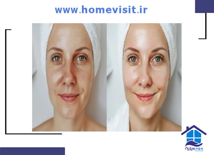 تمرین لبخند ملایم برای فلج  بلز