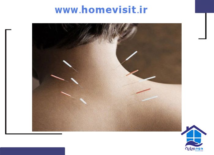طب سوزنی بر کاهش درد دیسک گردن