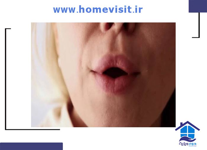 تمرین جمع کردن لب ها برای فلج بلز