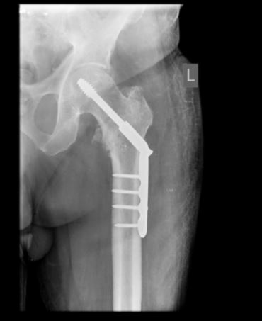 رادیوگرافی استخوان ران از نمای AP