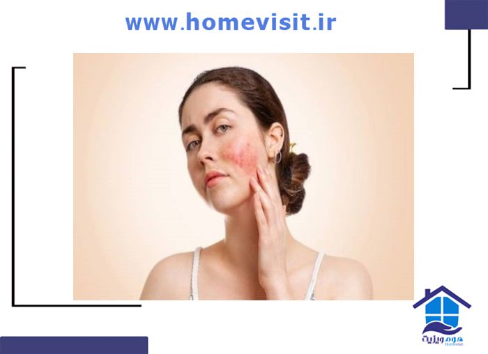راهکارهای درمانی برای مدیریت لوپوس