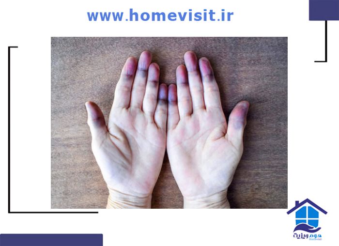 سیانوتیک قلب و خطرات ناشی از آن‌ها