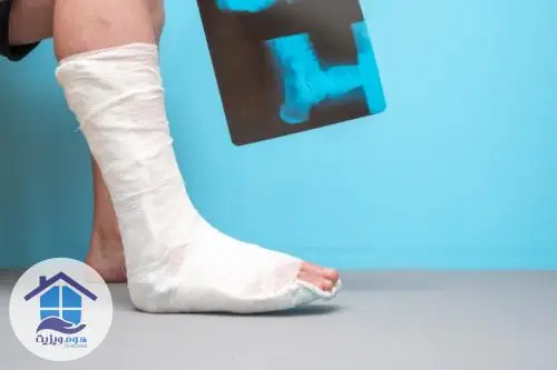 درمان شکستگی در ناحیه ی مچ پا 