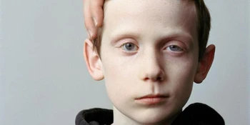 فیزیوتراپی فلج بلز، فلج صورت