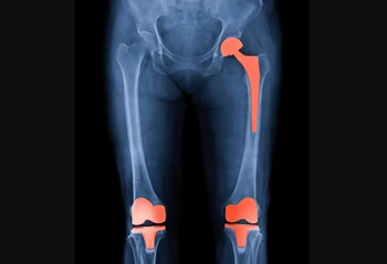 رادیولوژی یا ایکس ری برای آرتروز